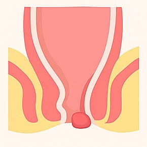Anal Fistula Treatment