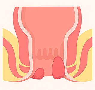 Piles (Hemorrhoids) Treatment